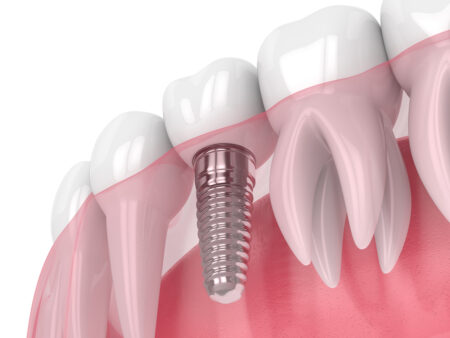 Rendering of a dental implant in a row of natural teeth.