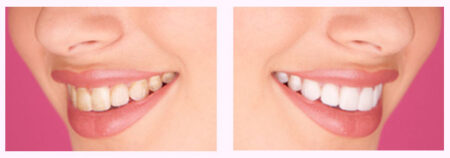 Side-by-side photos of a woman's smile both before and after teeth whitening.