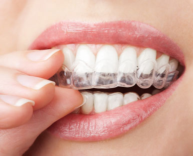 Up-close photo of a woman's smile as she inserts a teeth whitening tray.