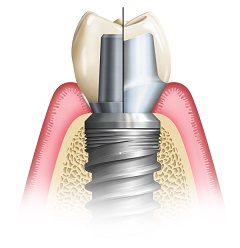 Diagram illustrating the excellence in fit offered by custom abutments for dental implants, as compared to stock abutments.