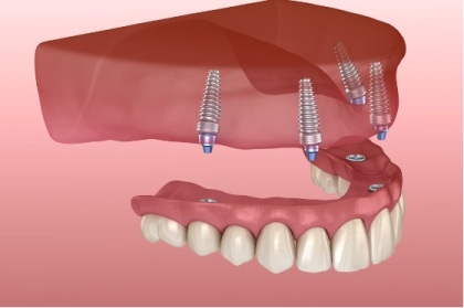 Implant supported dentures