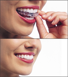 Images of a patient putting on an Invisalign aligner