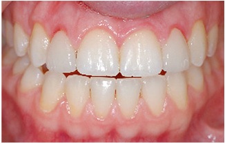 Example of cosmetic dental work with inflamed gums