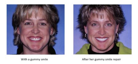 Before and after a gummy smile